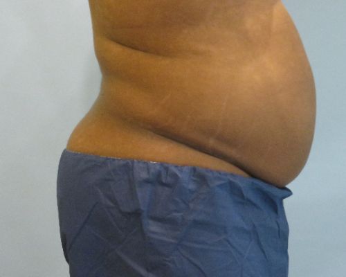 Smart Liposuction | Liposuction Before and After Case 4