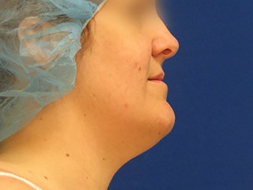 SmartLipo Neck Before & After case 1
