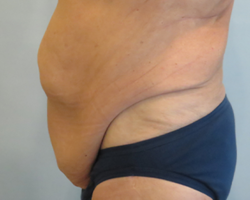 Tummy Tuck Before & After