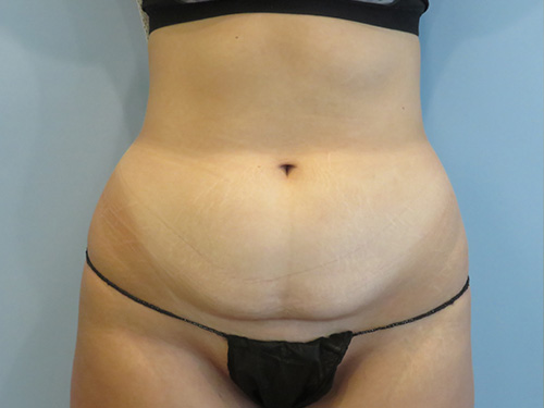 Tummy Tuck | 360 Body Lift Befor and After case 7