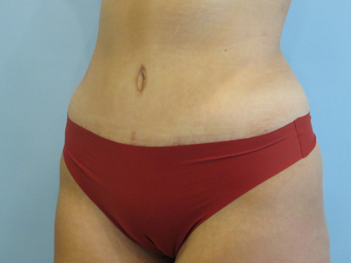 Tummy Tuck | 360 Body Lift Befor and After case 7
