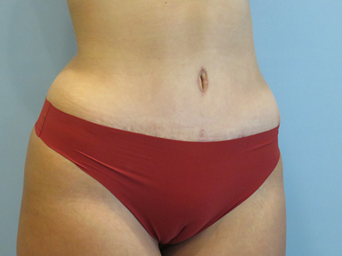 Tummy Tuck | 360 Body Lift Befor and After case 7