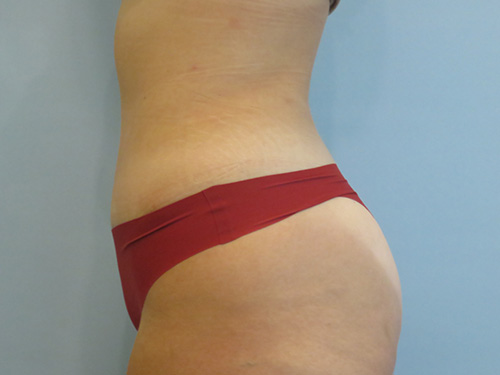 Tummy Tuck | 360 Body Lift Befor and After case 7