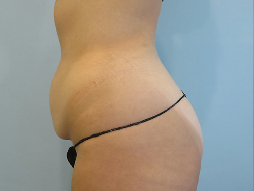 Tummy Tuck | 360 Body Lift Befor and After case 7