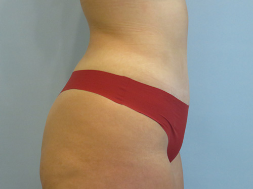 Tummy Tuck | 360 Body Lift Befor and After case 7