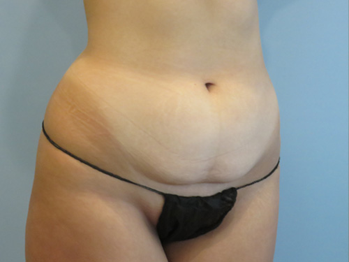 Tummy Tuck | 360 Body Lift Befor and After case 7