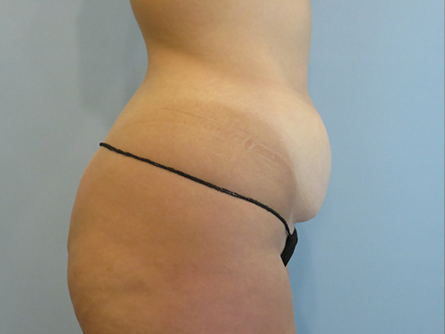 Tummy Tuck | 360 Body Lift Befor and After case 7