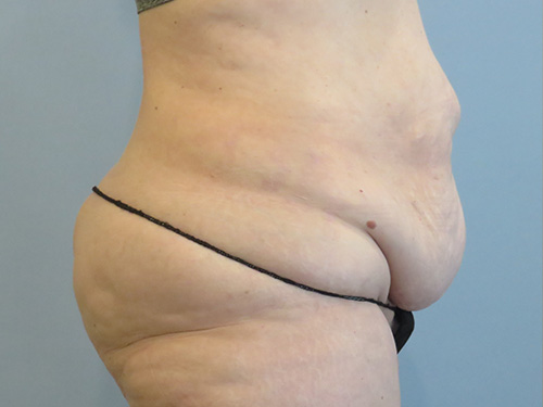 Tummy Tuck | 360 Body Lift Before & After case 10