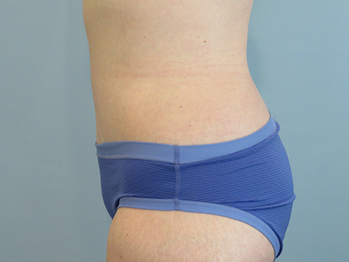 Tummy Tuck | 360 Body Lift Before & After case 10