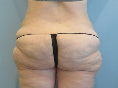 Tummy Tuck | 360 Body Lift Before & After case 10