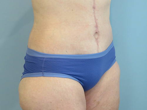 Tummy Tuck | 360 Body Lift Before & After case 10