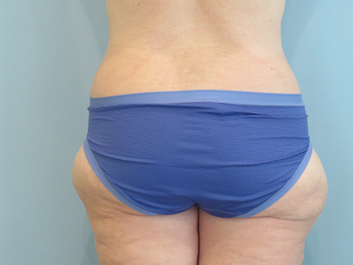 Tummy Tuck | 360 Body Lift Before & After case 10
