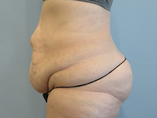 Tummy Tuck | 360 Body Lift Before & After case 10