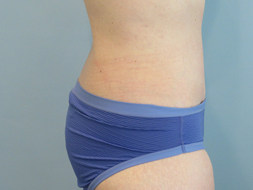 Tummy Tuck | 360 Body Lift Before & After case 10