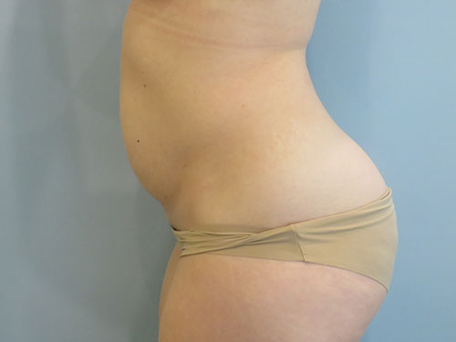 Tummy Tuck | 360 Body Lift Before & After case 11