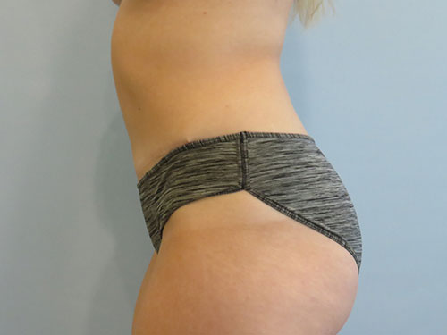 Tummy Tuck | 360 Body Lift Before & After case 11