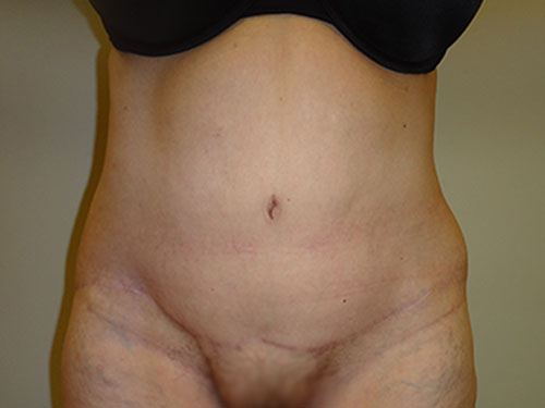 Tummy Tuck | 360 Body Lift Before & After case 12