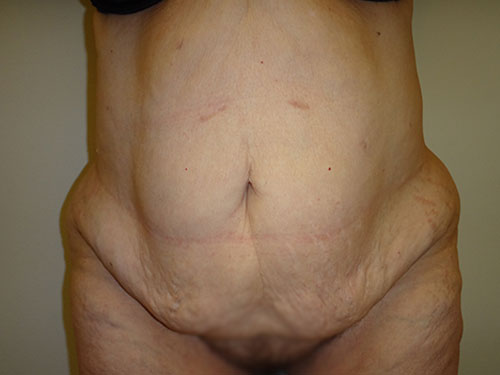 Tummy Tuck | 360 Body Lift Before & After case 12
