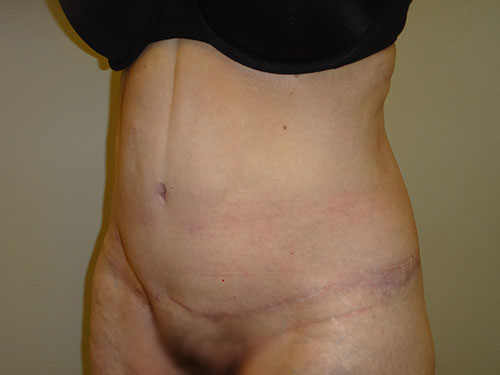 Tummy Tuck | 360 Body Lift Before & After case 12