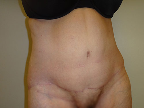 Tummy Tuck | 360 Body Lift Before & After case 12