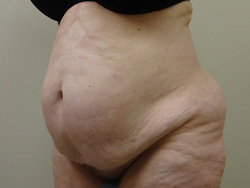 Tummy Tuck | 360 Body Lift Before & After case 12