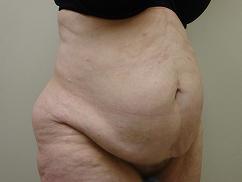 Tummy Tuck | 360 Body Lift Before & After case 12