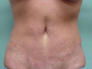 Tummy Tuck | 360 Body Lift Before & After case 13