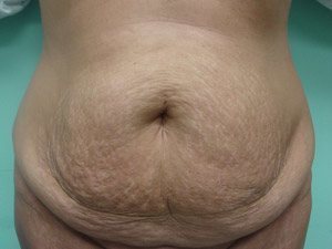 Tummy Tuck | 360 Body Lift Before & After case 13