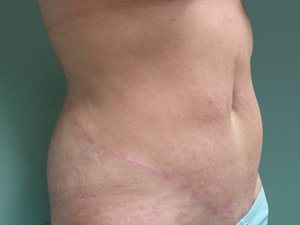Tummy Tuck | 360 Body Lift Before & After case 13