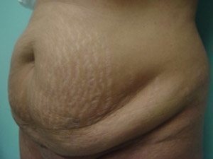 Tummy Tuck | 360 Body Lift Before & After case 13