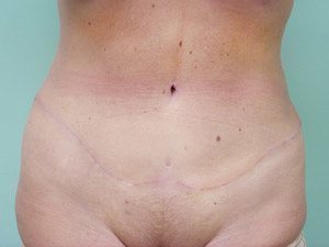 Tummy Tuck | 360 Body Lift Before & After case 14