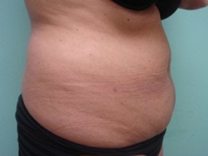 Tummy Tuck | 360 Body Lift Before & After case 14