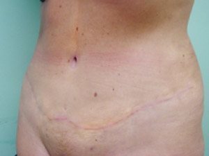 Tummy Tuck | 360 Body Lift Before & After case 14
