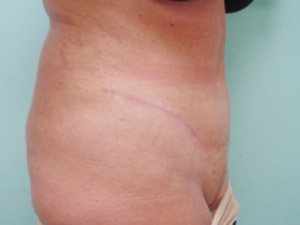 Tummy Tuck | 360 Body Lift Before & After case 14