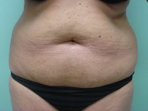 Tummy Tuck | 360 Body Lift Before & After case 14