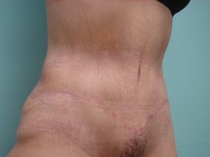 Tummy Tuck | 360 Body Lift Before & After case 15