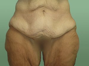 Tummy Tuck | 360 Body Lift Before & After case 15