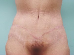 Tummy Tuck | 360 Body Lift Before & After case 15