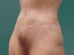 Tummy Tuck | 360 Body Lift Before & After case 15