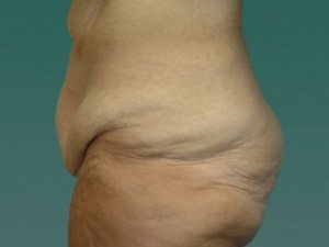 Tummy Tuck | 360 Body Lift Before & After case 15