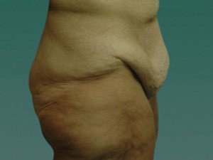 Tummy Tuck | 360 Body Lift Before & After case 15