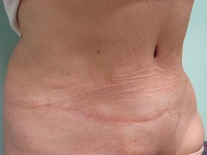 Tummy Tuck | 360 Body Lift Before & After case 16
