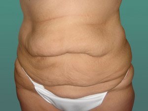 Tummy Tuck | 360 Body Lift Before & After case 16