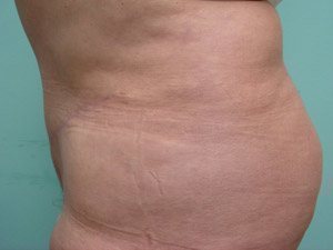 Tummy Tuck | 360 Body Lift Before & After case 16