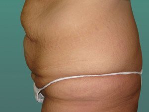 Tummy Tuck | 360 Body Lift Before & After case 16
