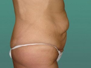 Tummy Tuck | 360 Body Lift Before & After case 16