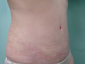 Tummy Tuck | 360 Body Lift Before & After case 17