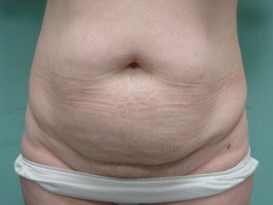 Tummy Tuck | 360 Body Lift Before & After case 17