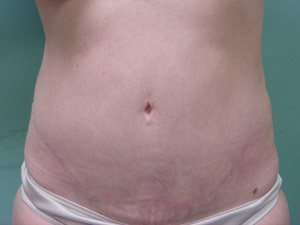 Tummy Tuck | 360 Body Lift Before & After case 17