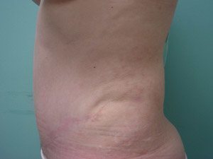 Tummy Tuck | 360 Body Lift Before & After case 17